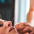 Finding a Qualified Acupuncturist for Holistic Health and Anti-Aging